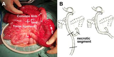 Risk Factor and Surgical Outcome of Petersen’s Hernia After Gastrectomy in Gastric Cancer